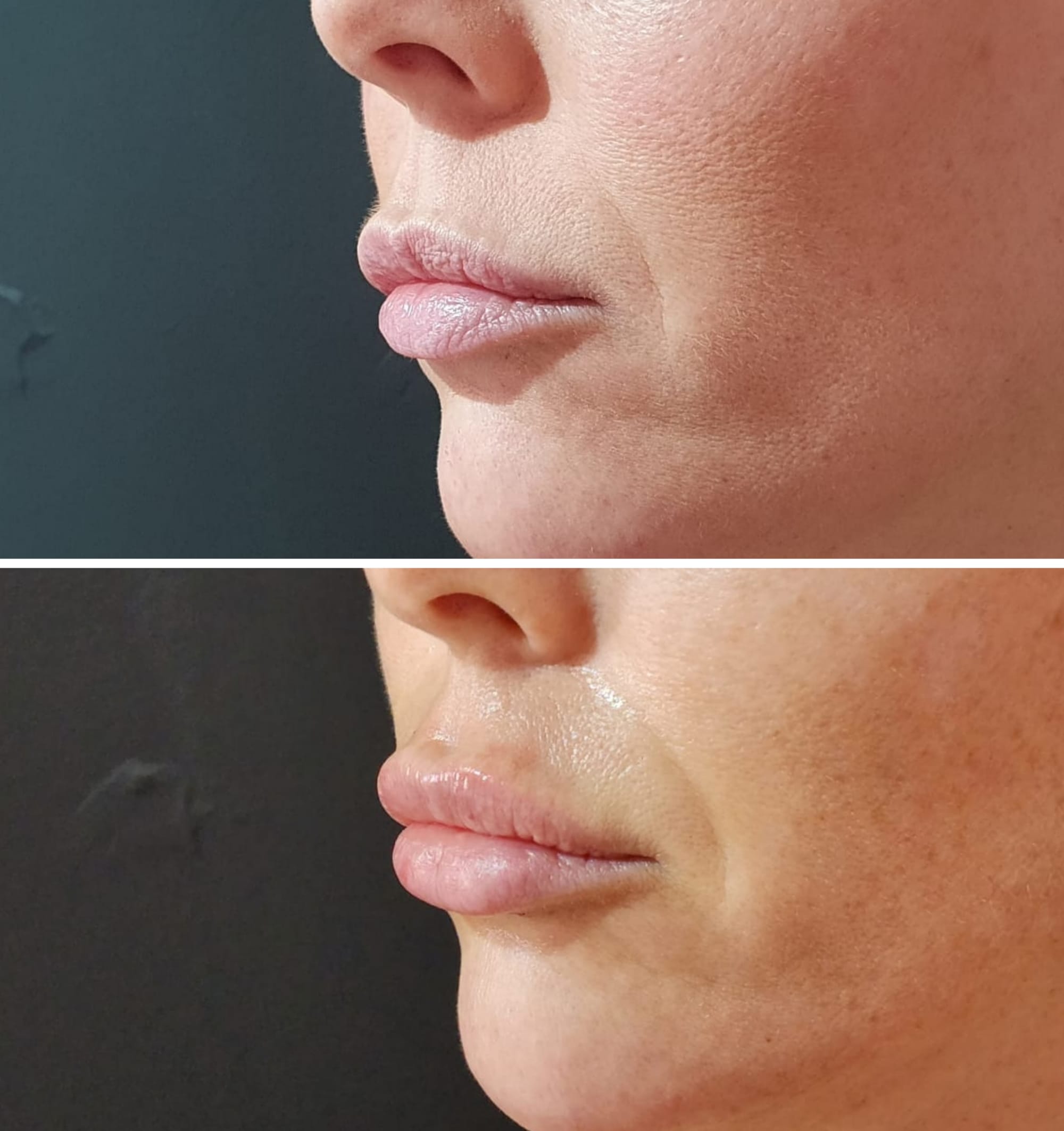 Fillers (Hyaluronic Acid)