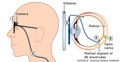 A-Implant rétinal