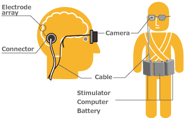 Implant cortical