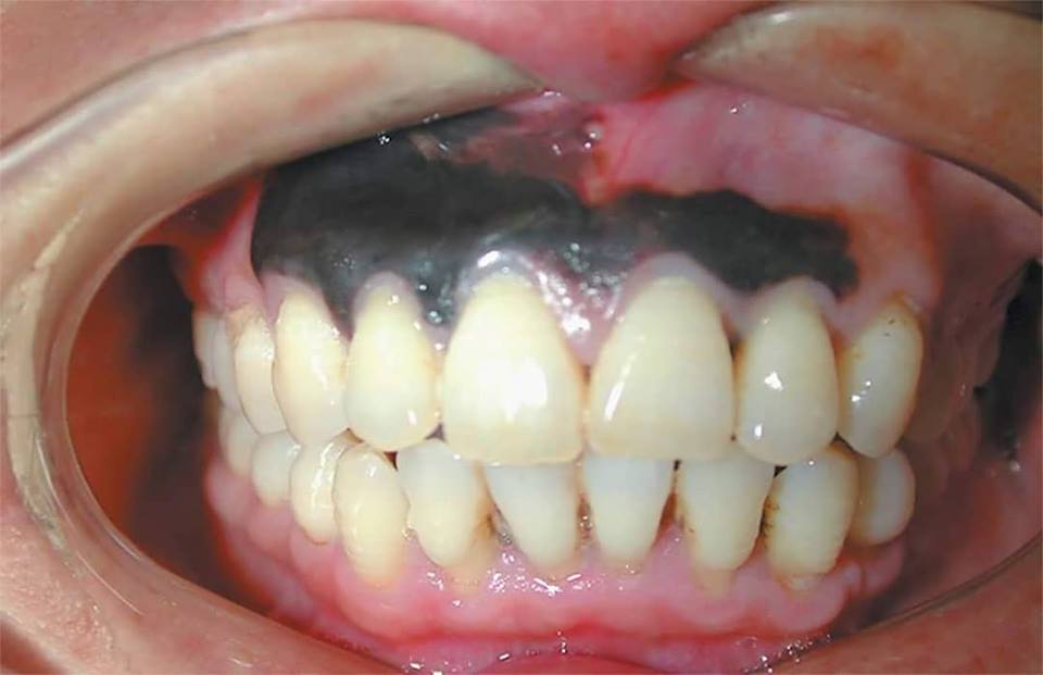 Mélanome gingival