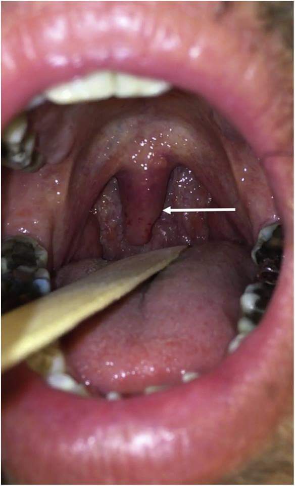 Uvulite : un diagnostic rare mais simple