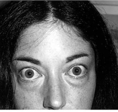 ophtalmopathie basedowienne