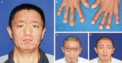 Pachydermopériostose