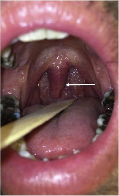 Uvulite : un diagnostic rare mais simple