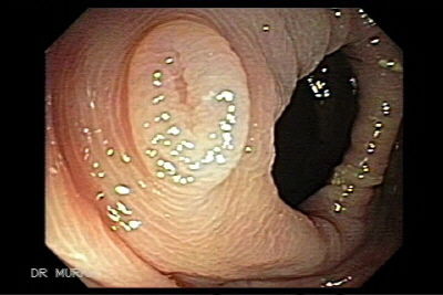 La fiesta de la purulencia     por Joan Villanueva