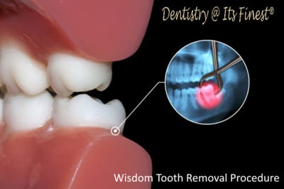 How Is Wisdom Tooth Removal Performed?