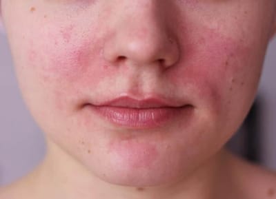 Best Rosacea Treatment London image