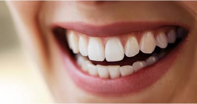 What Are the Advantages of Six Month Smiles in a Dental Clinic in Houston?