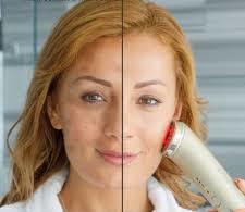 Led Light Therapy Facial