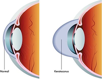 Keratoconus treatment in India - Ojas eye Hospital