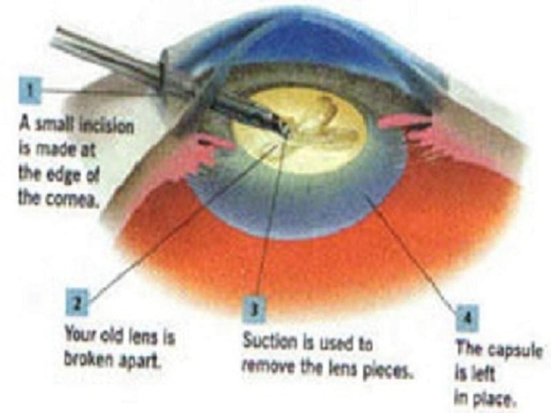 Cataract Surgery In India
