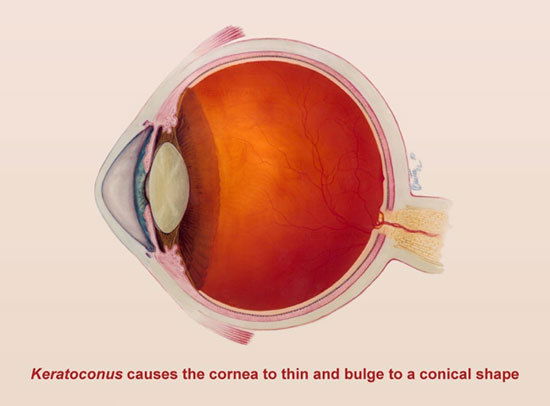 Keratoconus Treatment in India - Ojas Eye Hospital