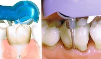 ВЕКТОР-ТЕРАПИЯ И ПАРОДОНТИТ.