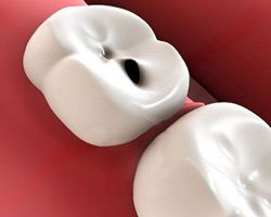 ВСЯ ПРАВДА О КАРИЕСЕ