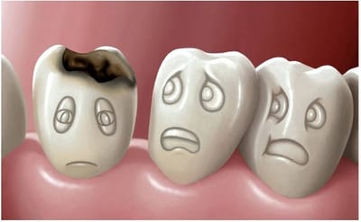 ЧЕМ ЧРЕВАТО ОТКЛАДЫВАНИЕ ЛЕЧЕНИЯ КАРИЕСА «НА ПОТОМ»