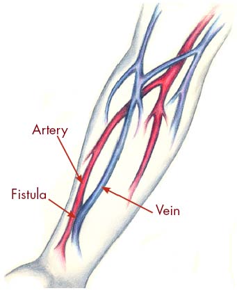 Vascular Access