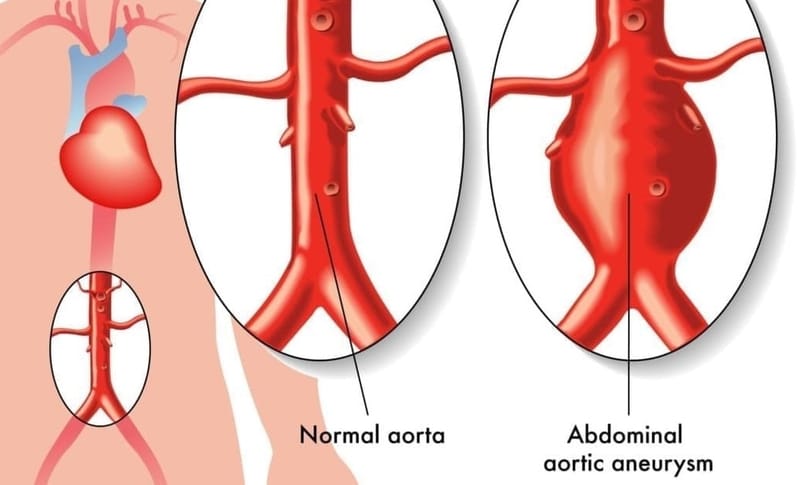 Aortic Aneurysm