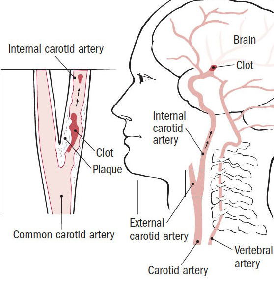 Carotid Artery Stenosis