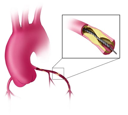 Angioplasty & Vascular stenting