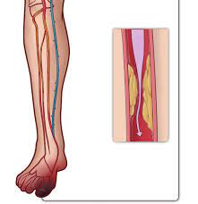 Critical Limb Ischemia