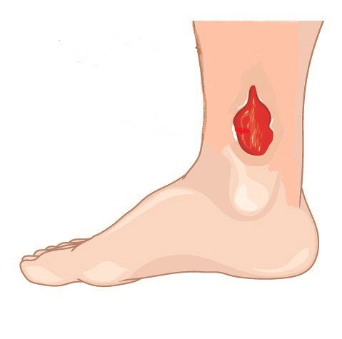 Leg Ulcers
