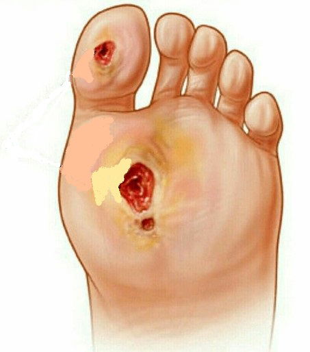Diabetic Foot