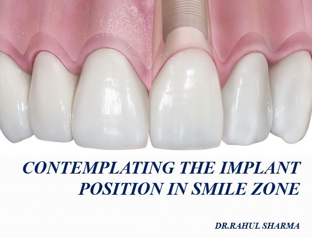 Contemplating the Implant position in smile zone in 10thWorld Congress of Oral Implantology and AAID Global Conference