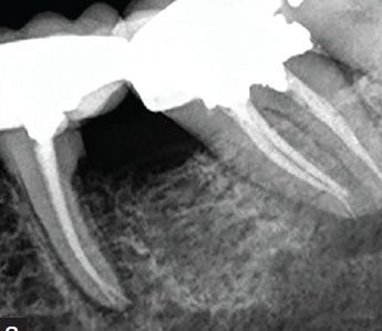 Salvaging a compromised tooth by an inter-disciplinary approach - A case report  in 6 th national conference of Indian society of Prosthodontics- Restorative-Periodontics(ISPRP)