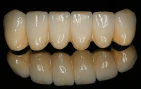 Management of failed FPD in 4th national conference of Indian society ofProsthodontics-Restorative-Periodontics (ISPRP)