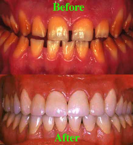Amelogenesis Imperfecta: A full mouth rehabilitation