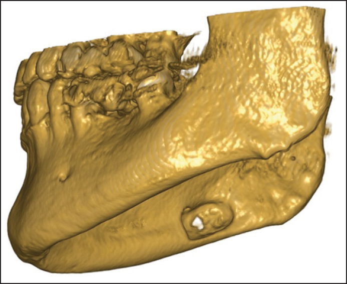 Stafne’s Bone Cavity - Enhancement In Complete Denture Retention