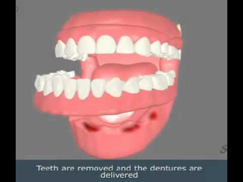 Immediate denture- An Important treatment modality