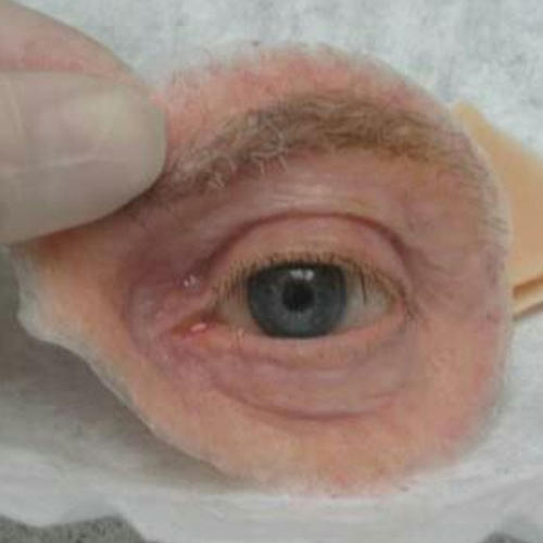 Rehabilitation Of An Ocular Defect