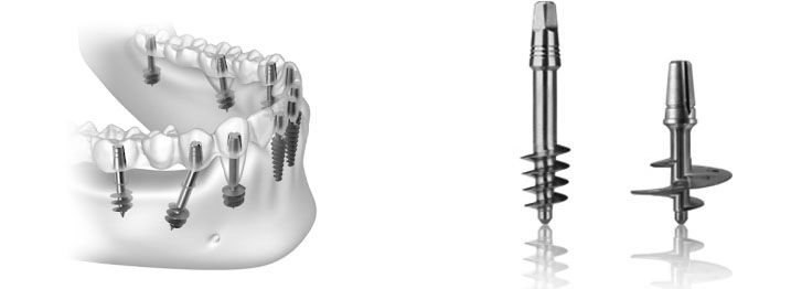 Basal Implants – An Alternate Treatment Modality For Atrophied Ridges