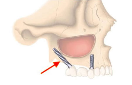Atrophied maxilla restored with a pterygo-maxillary implant – a case report