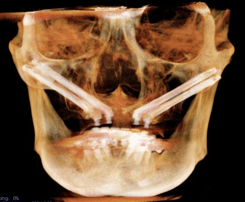 An Introduction to the longest fixtures – Zygomatic Implants