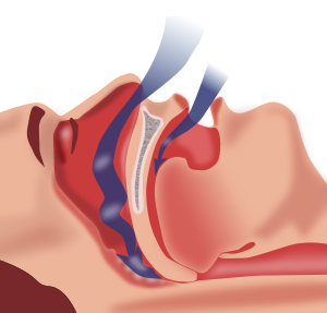 Sleep Apnea – relevance in dentistry, An error in sleep