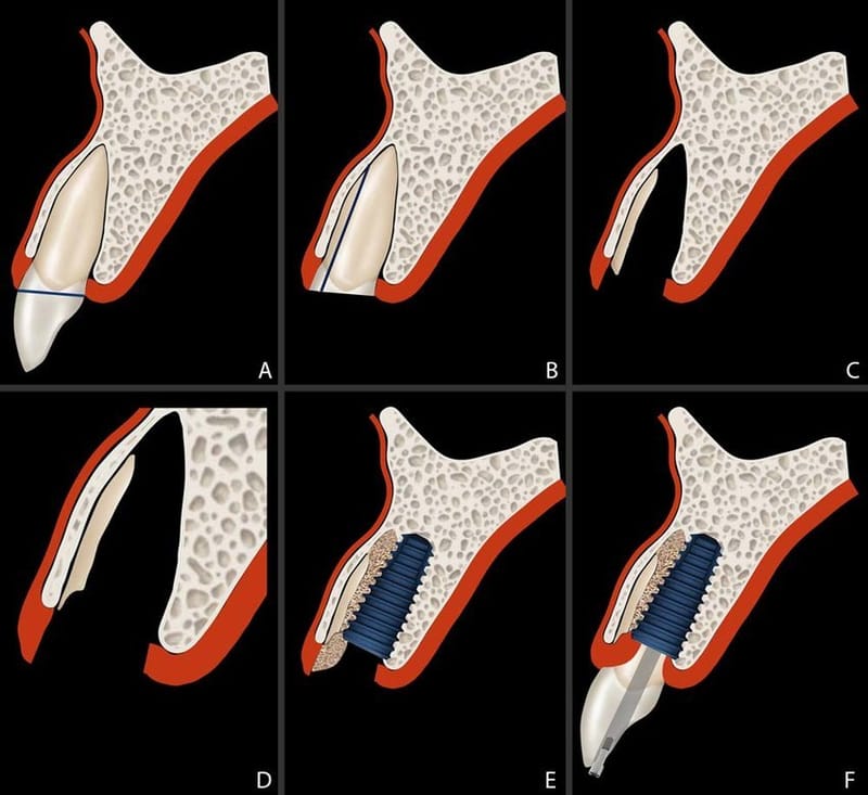 Socket Shield technique: Boon to Implant dentistry –A Review