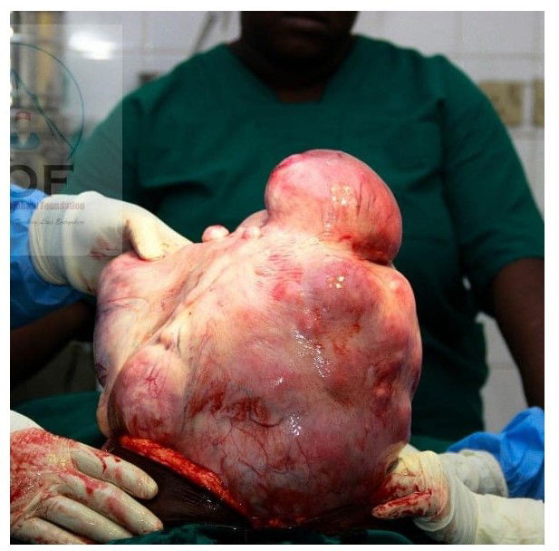 Graphic photos: Large mass removed from the stomach of a woman who appeared to be pregnant for 9 years