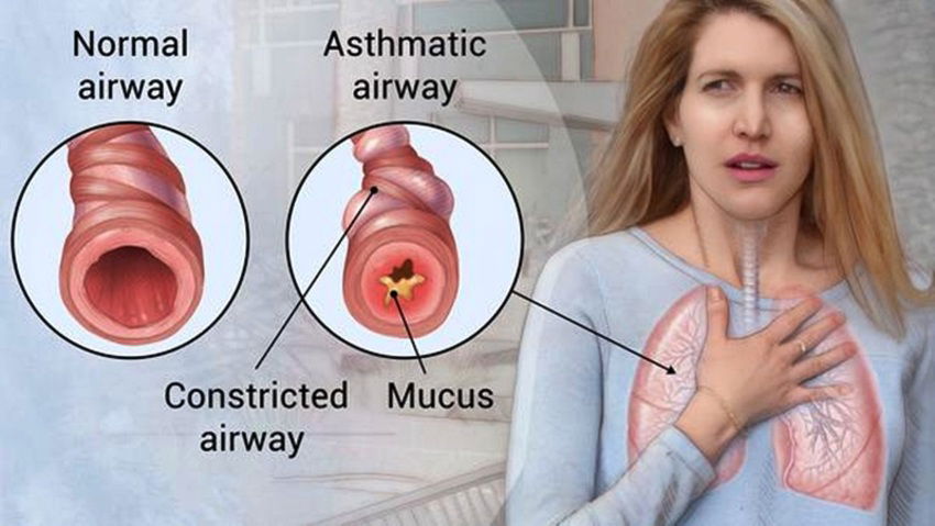 Cara Diagnosis Asma Anda