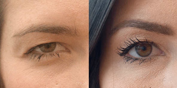 Botox For Eyelid Lift