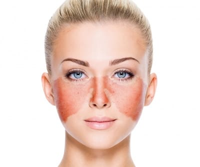 ENFERMEDADES MÁS COMUNES EN LA PIEL