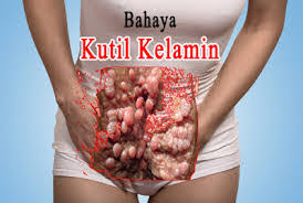 Apa Saja Gejala Penyakit Kutil Kelamin Perempuan