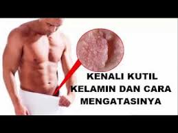 Cara Alami Mengobati Kutil di Alat Vital