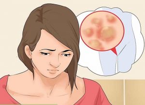 Cara Alami Mengobati Kutil Di Vagina