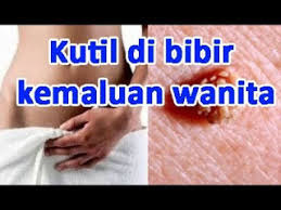Tips Alami Menyembuhkan Kutil Di Vagina
