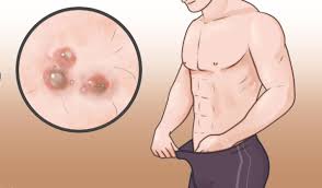 Tips Tradisional Menghilangkan Kutil Di Vagina