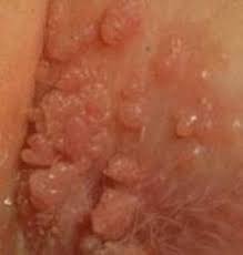 Cara Mudah Mengatasi Kutil Di Penis