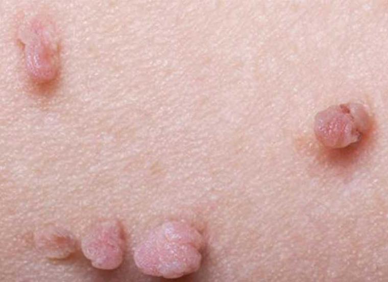 Tips Mudah Mengatasi Kutil Di Penis