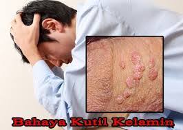 Tips Alami Menghilangkan Kutil Di Penis